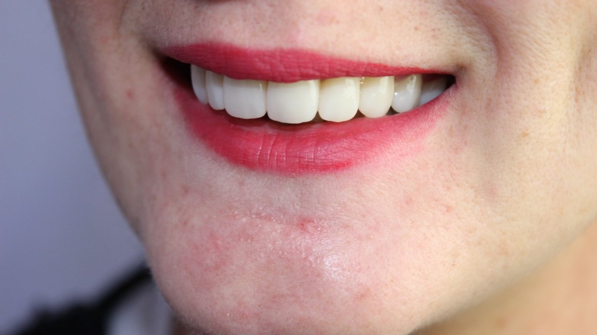 Riabilitazione estetica con corone in zirconia