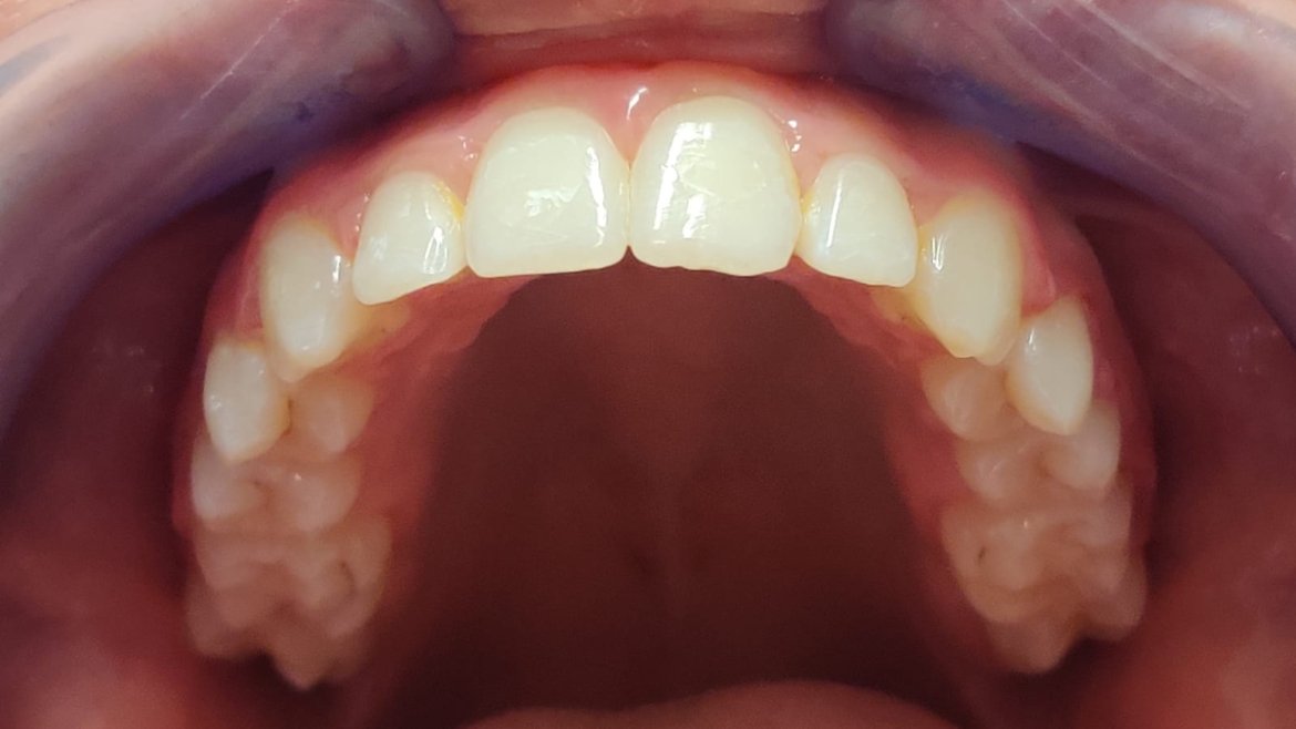 Malocclusione di II Classe – Terapia Ortodontica Fissa